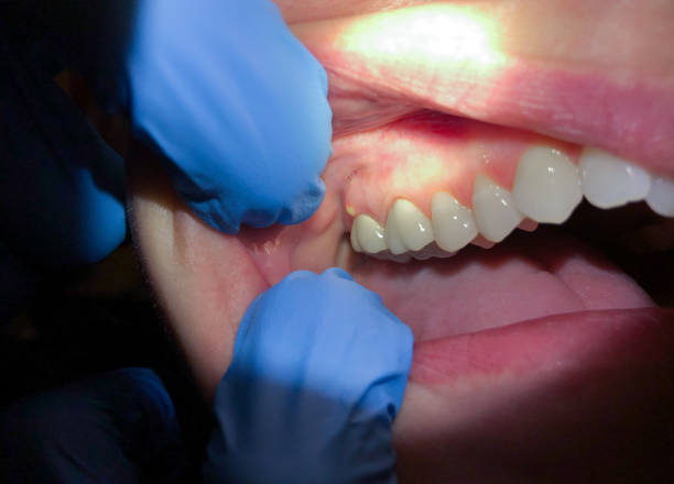 Best Emergency Denture Repair in South Bloomfield, OH